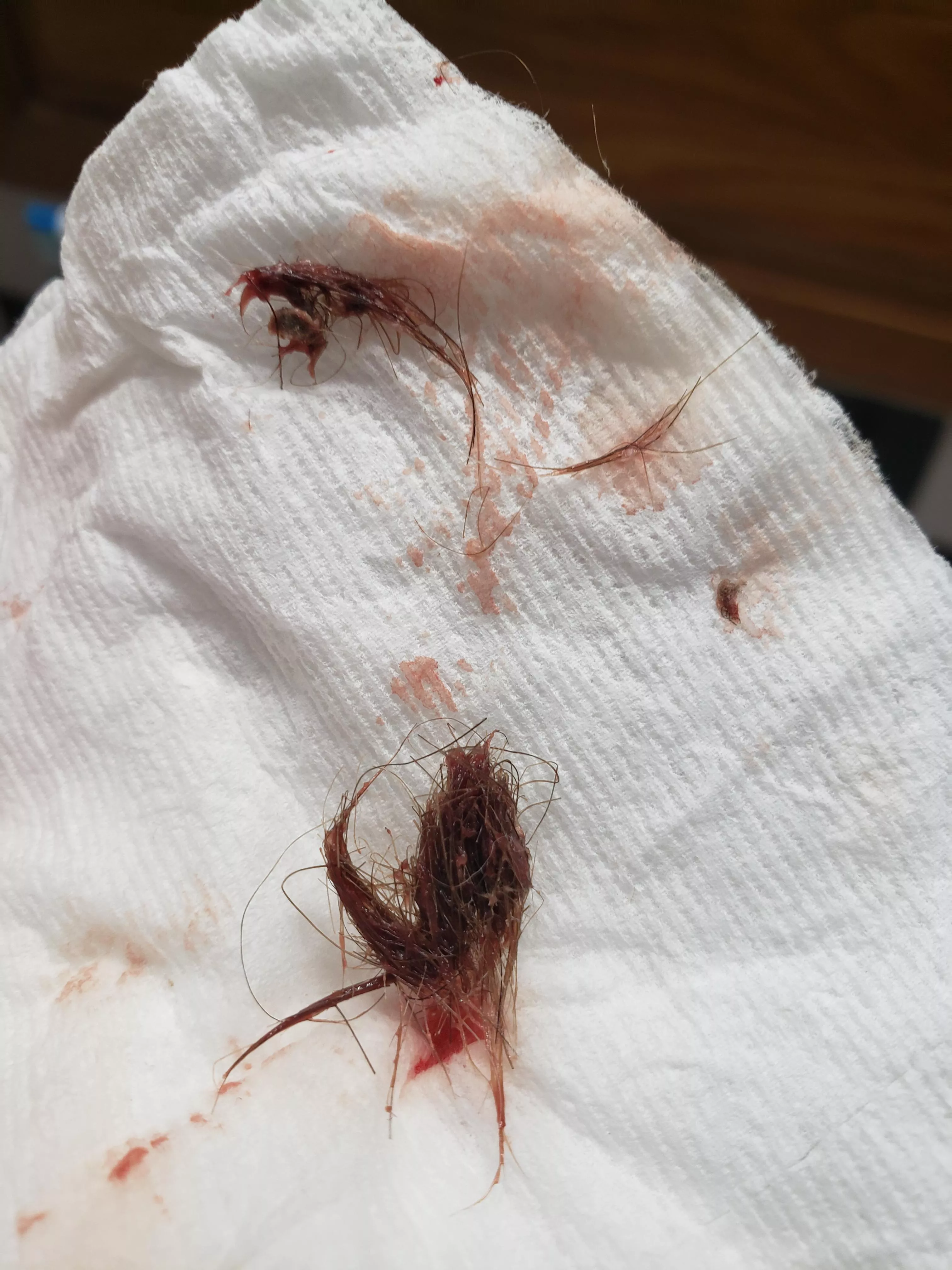 2 days ago my belly button began bleeding and had a slight discomfort sitting up and bending. It felt like it might have been a cyst. I put my finger in there and felt something, but couldn't quite reach it. Turns out it was a huge thing of hair? I've 