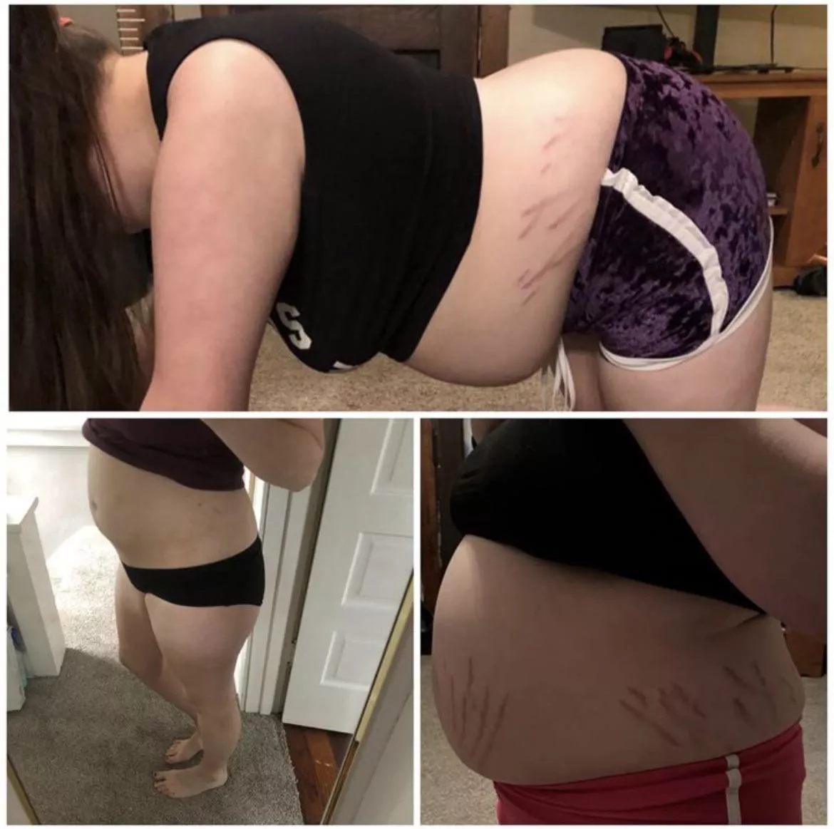 2 years ago when I was around 170 to around 220 in these photos! So many new stretch marks!