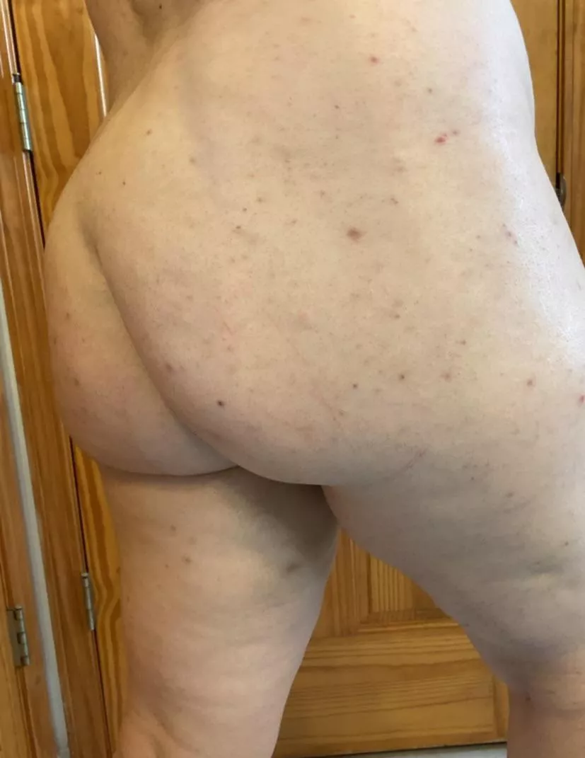 (28F 230lbs 5’5) I’m here to represent my people with spots all over our butts. Trying to overcome my hyperpigmentation problem!