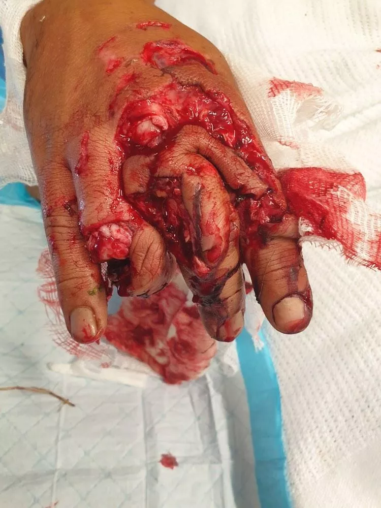 A friend of mine got his hand caught in some farm machinery.