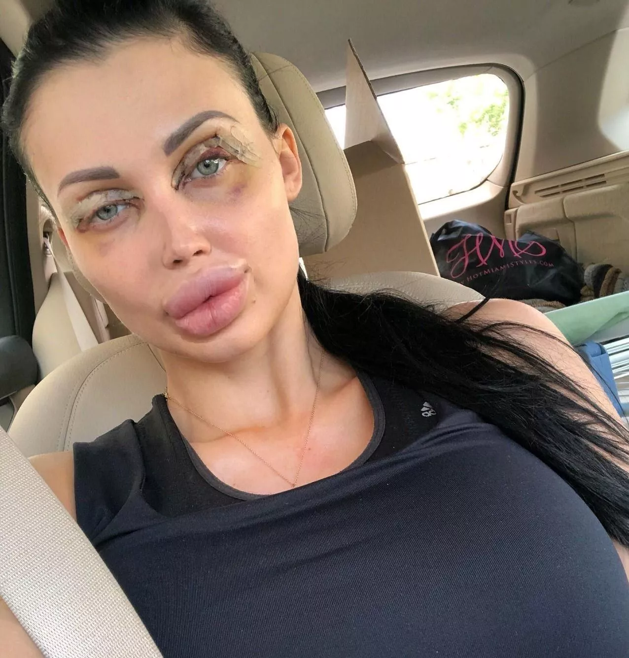 Aletta Ocean right after Surgery