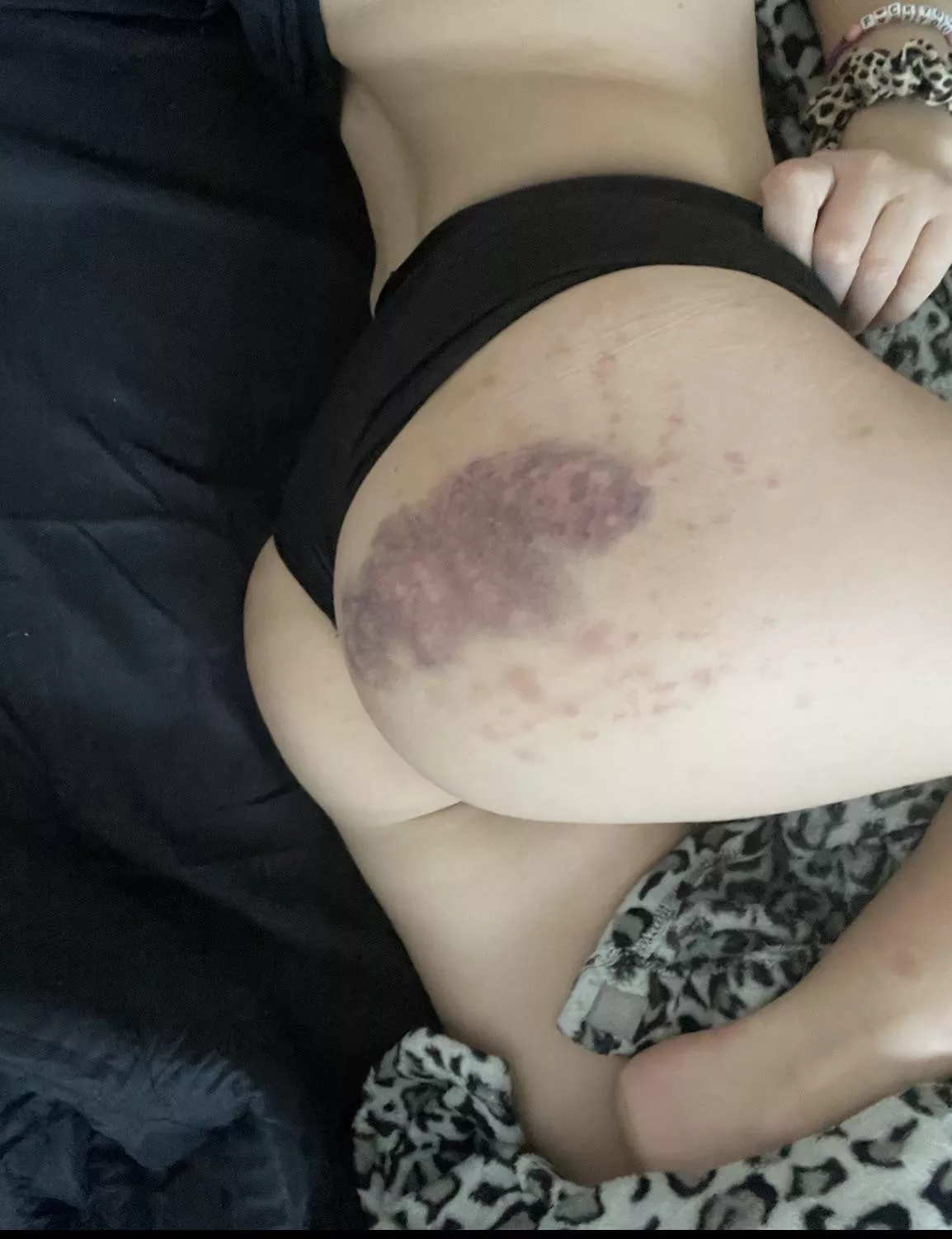 always admiring my spanking bruises ;) (f)