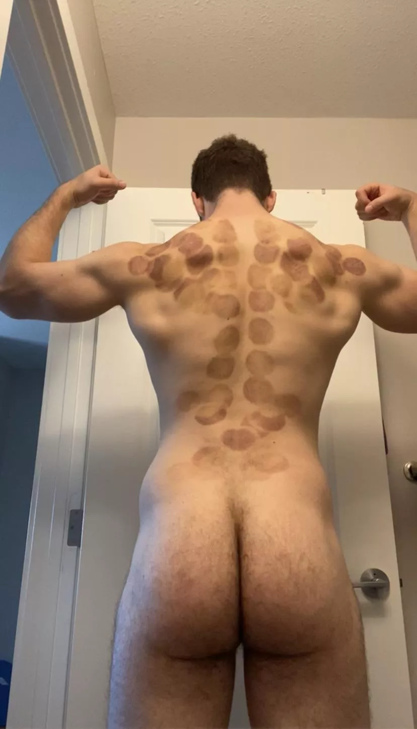 Anyone ever tried cupping?