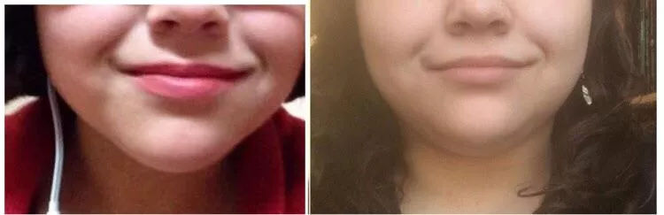 As requested, here’s my chin gains from 3 yrs ago- now 🐷