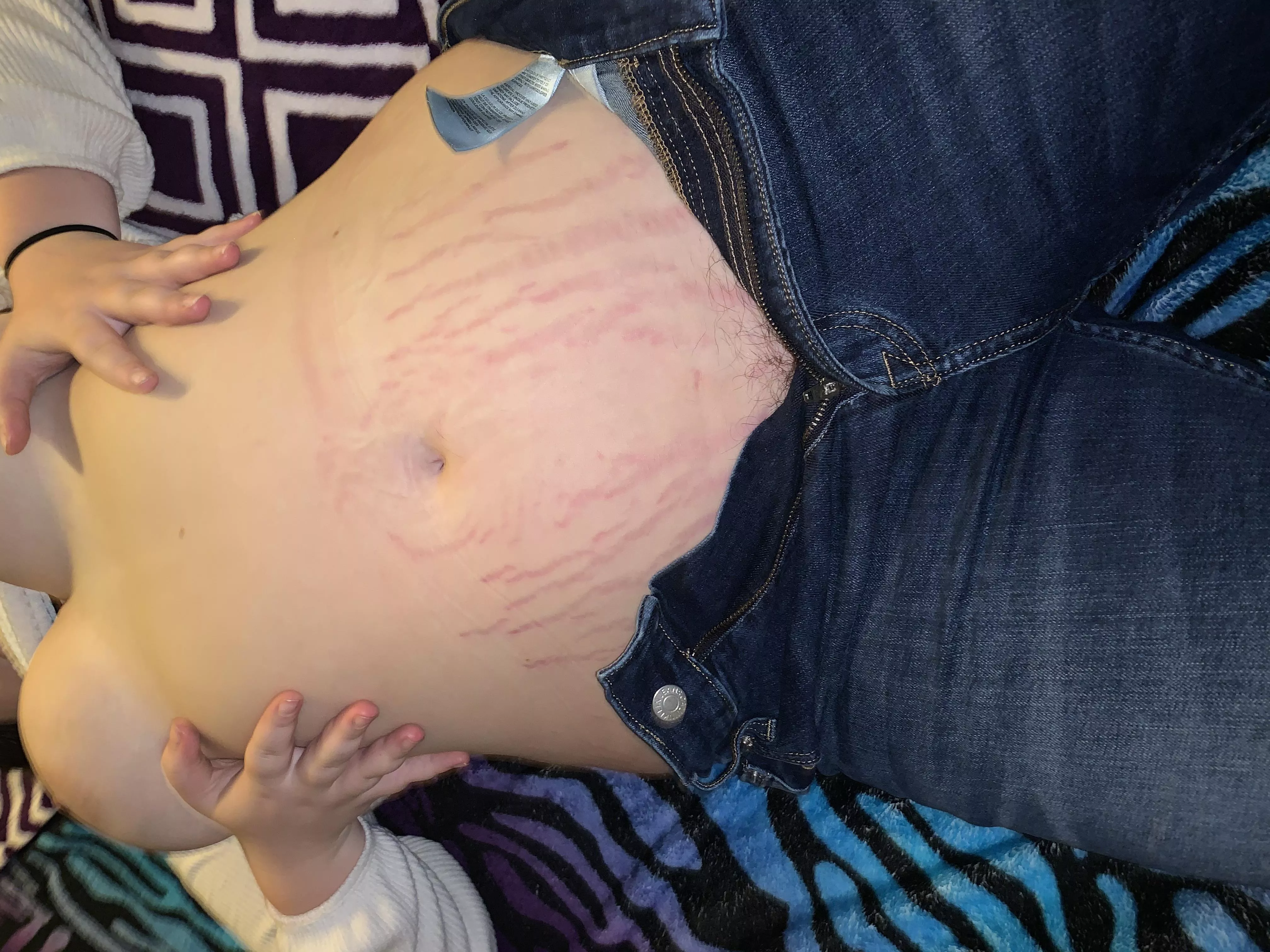 Can a body with stretch marks still be perfect?