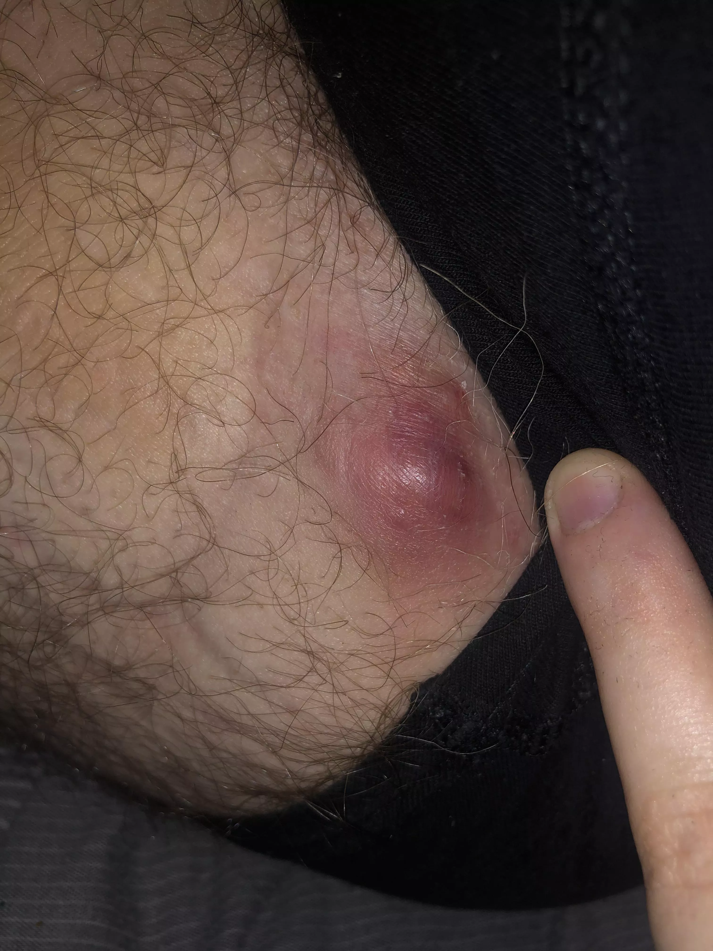 Can anyone tell me what this is please? No head, deep bump felt and growing. Groin area!