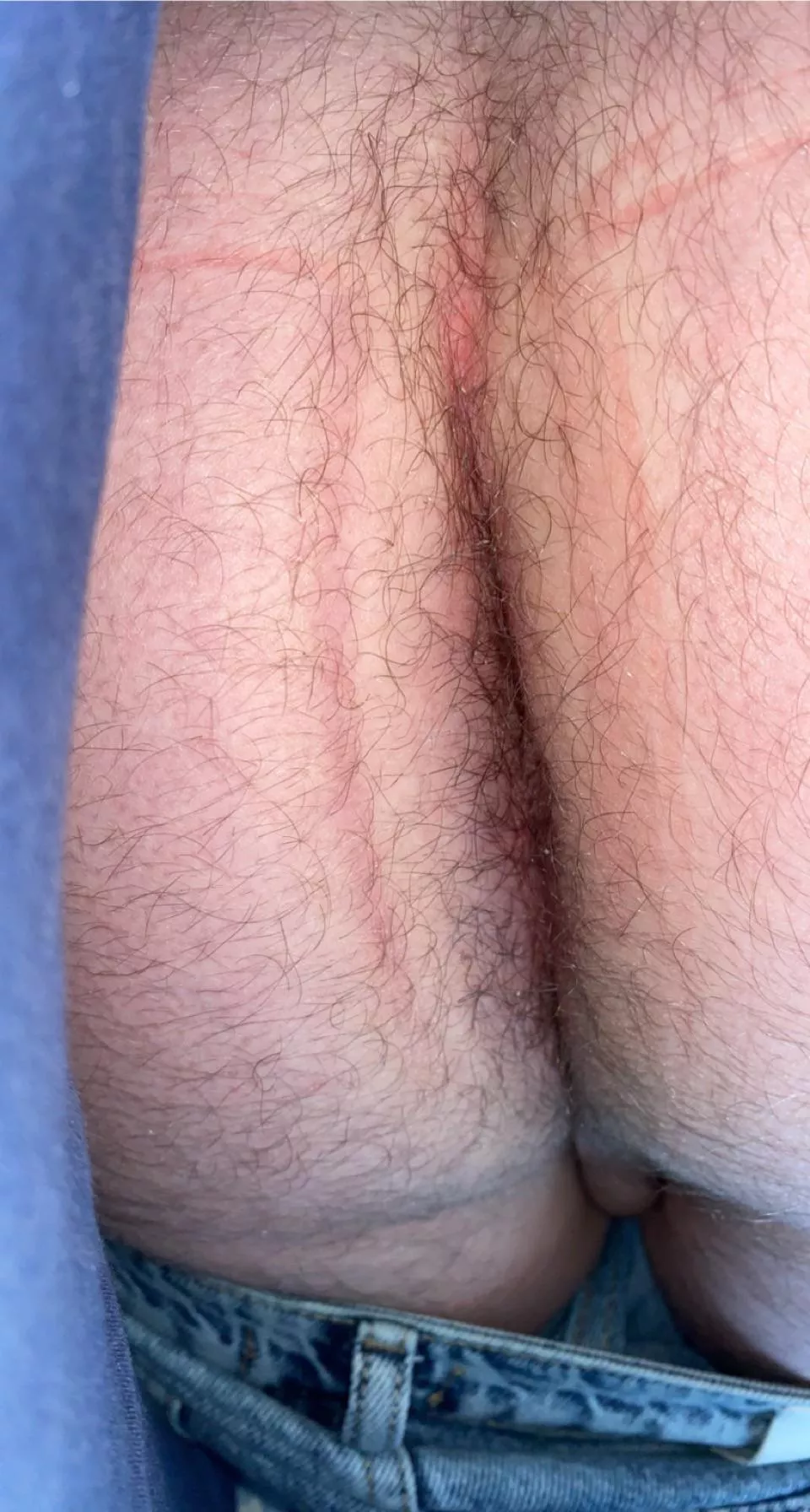 Do hairy holes belong here?