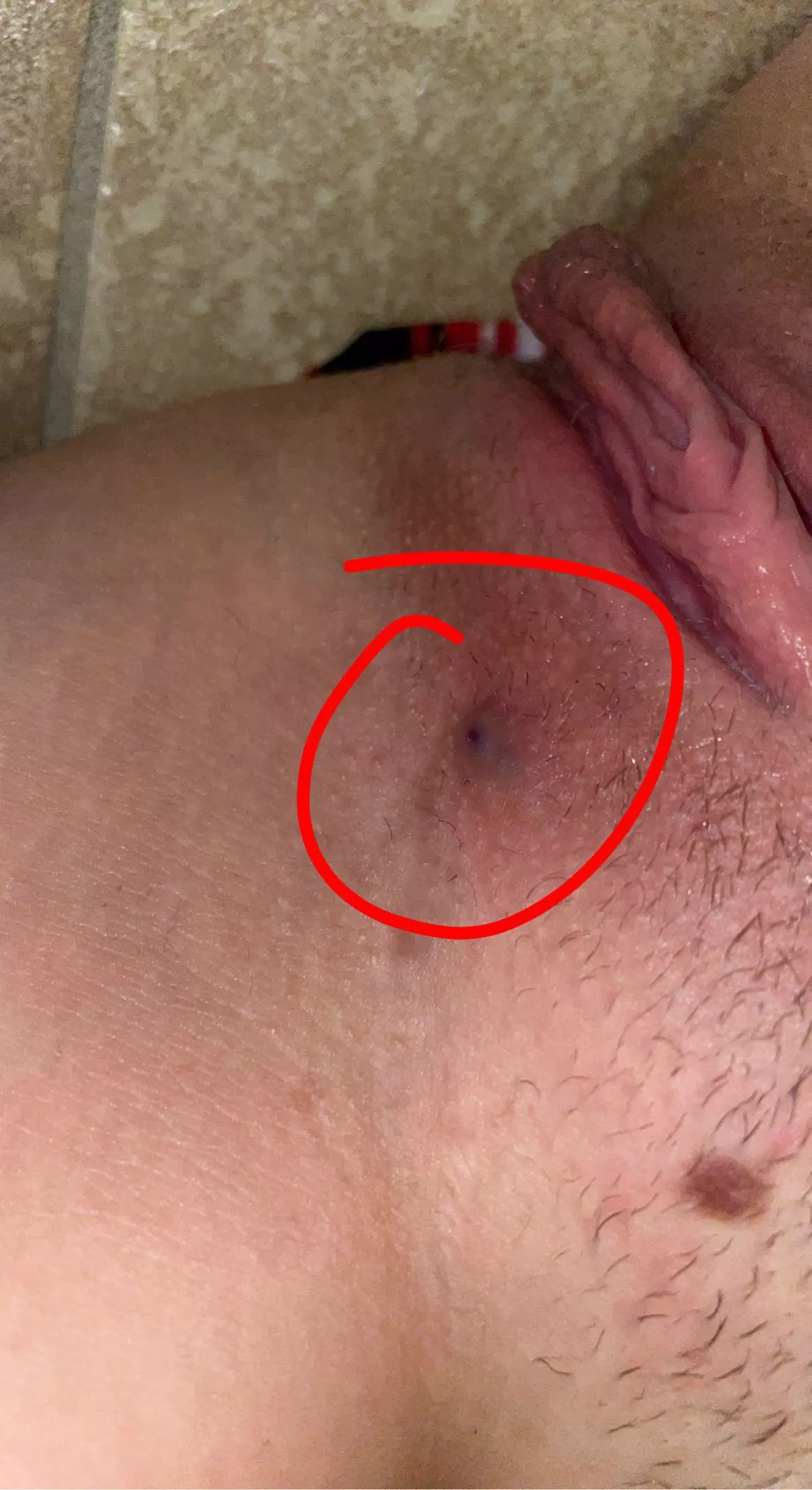 f19 5â€™5 120lb does anybody know what this is? iâ€™ve been tested and i know im clean but this bump hurts and just wonâ€™t go away :/