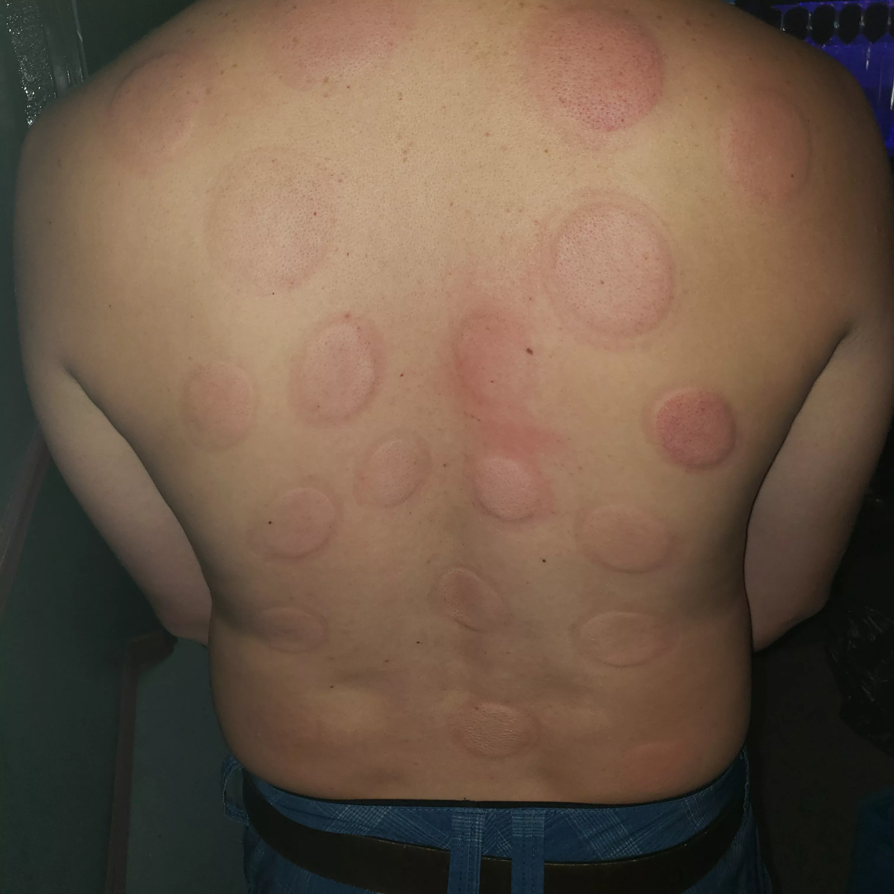 First time fire cupping! One of my favorites