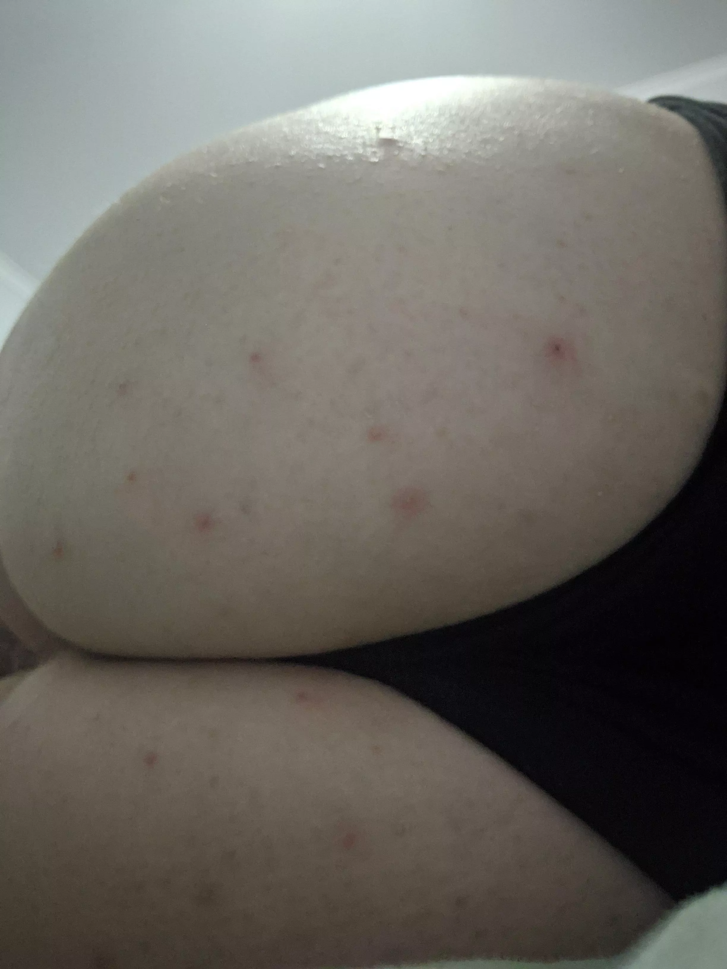 For some reason I keep getting butt pimples. NSFW because butt.