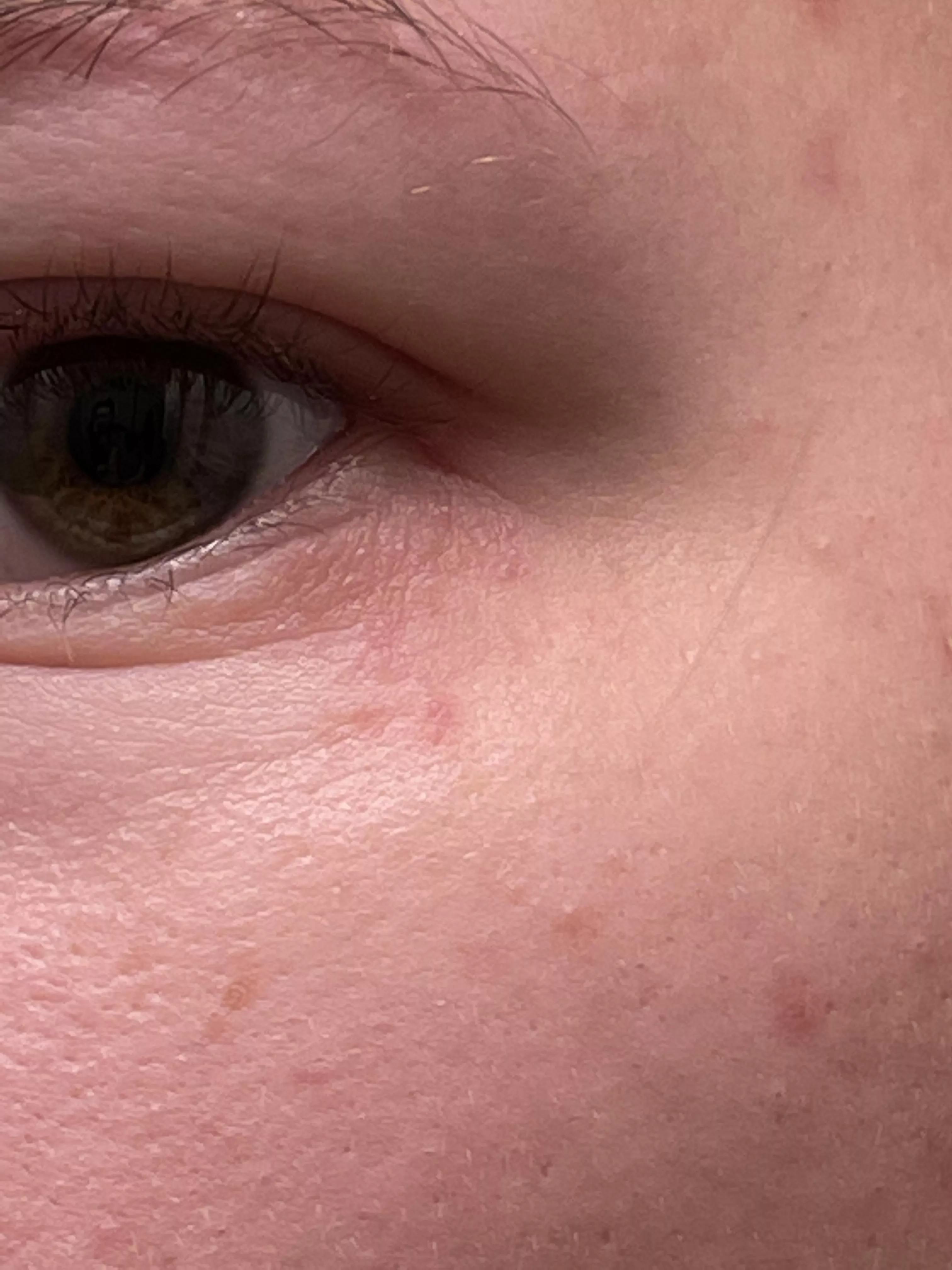 Forbidden pops under my left eye. Any idea what these are? They’ve been here for weeks.