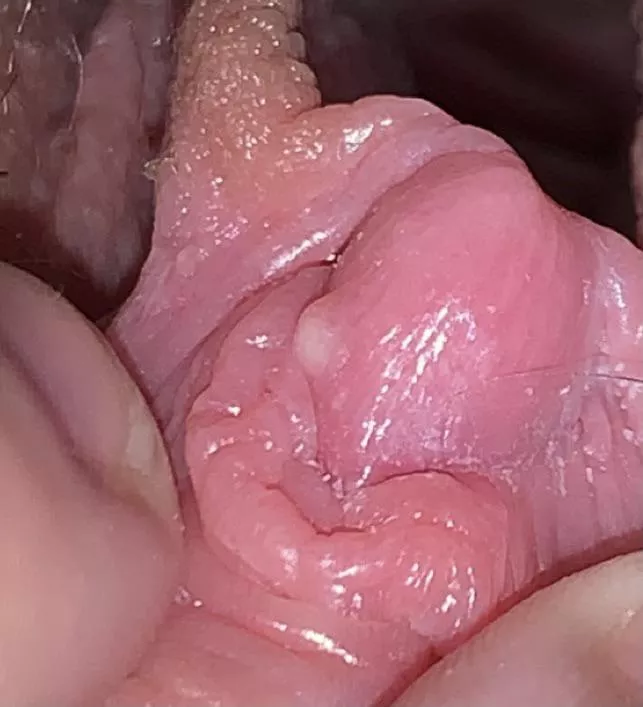 forbidden whitehead, LITERALLY on my clit. not painful or bothering me at all but i KNOW ITâ€™S THERE and itâ€™s driving me nuts