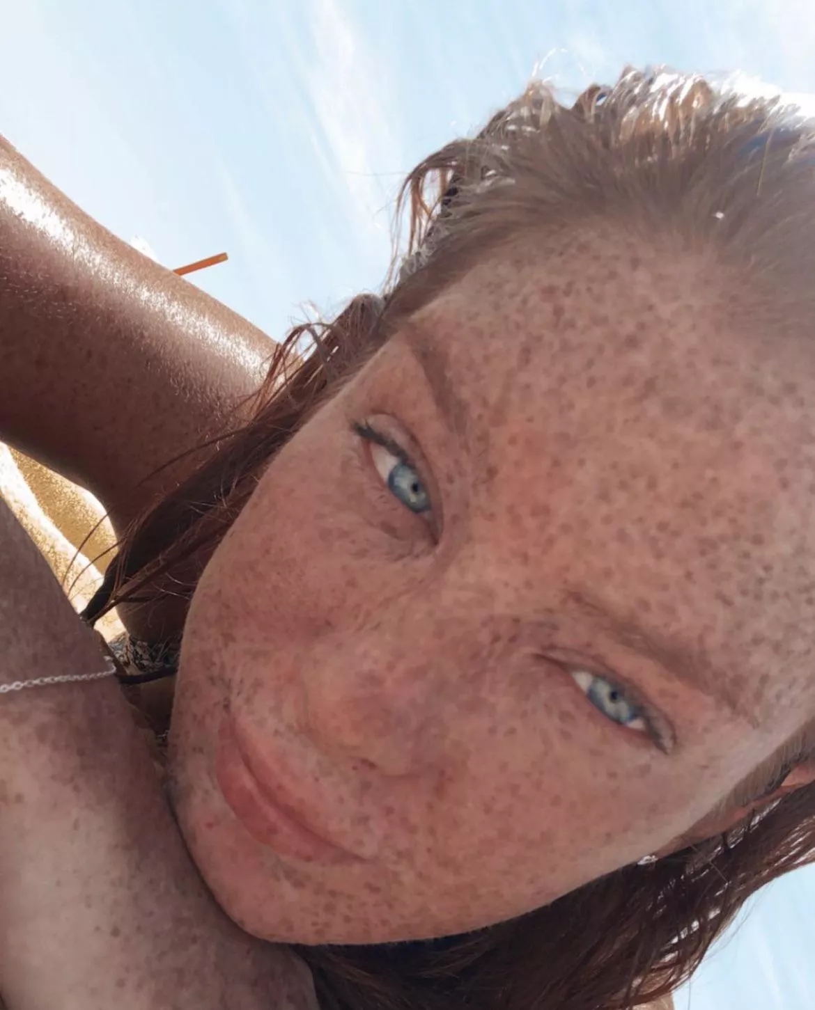 Freckle Face