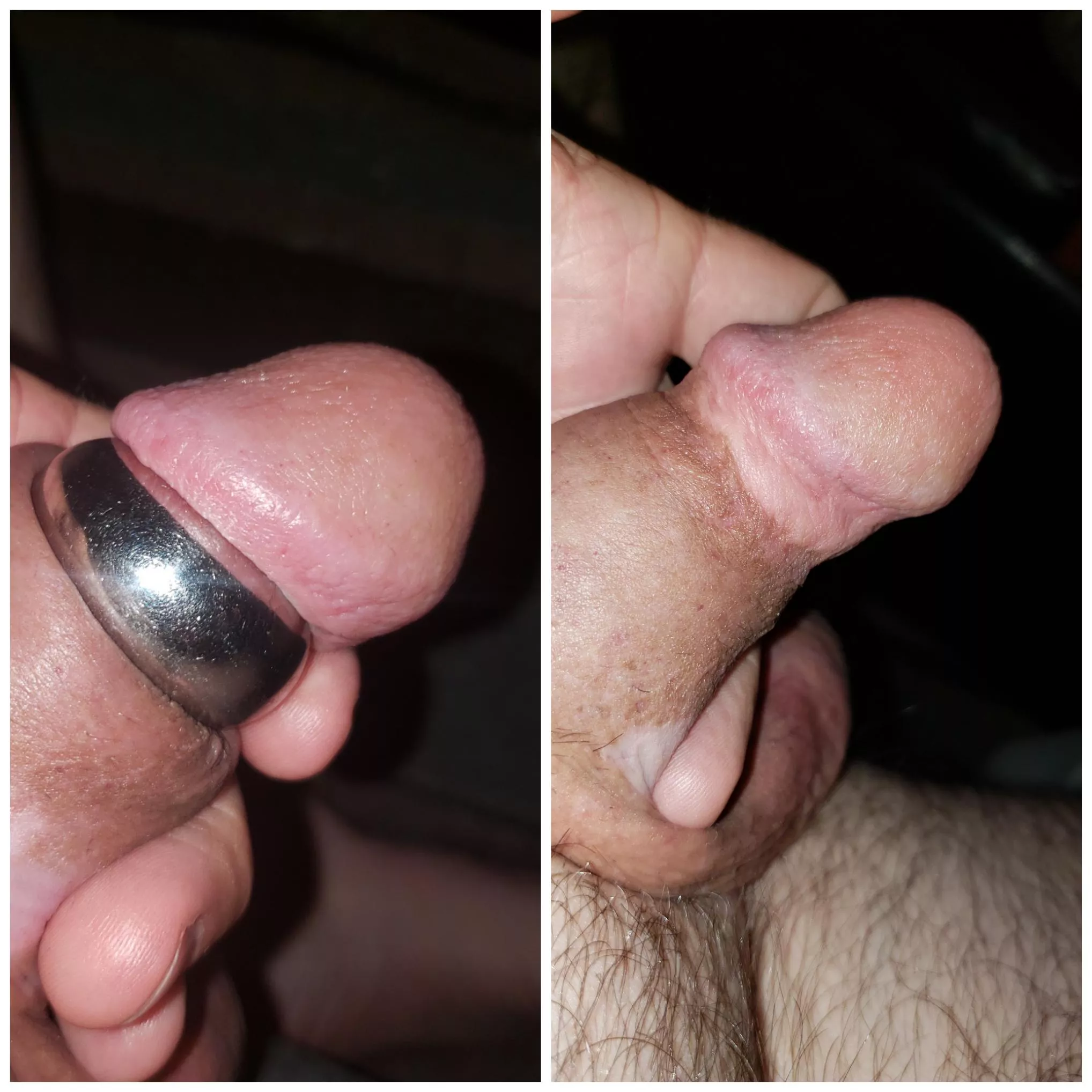 Glans ring and pumped