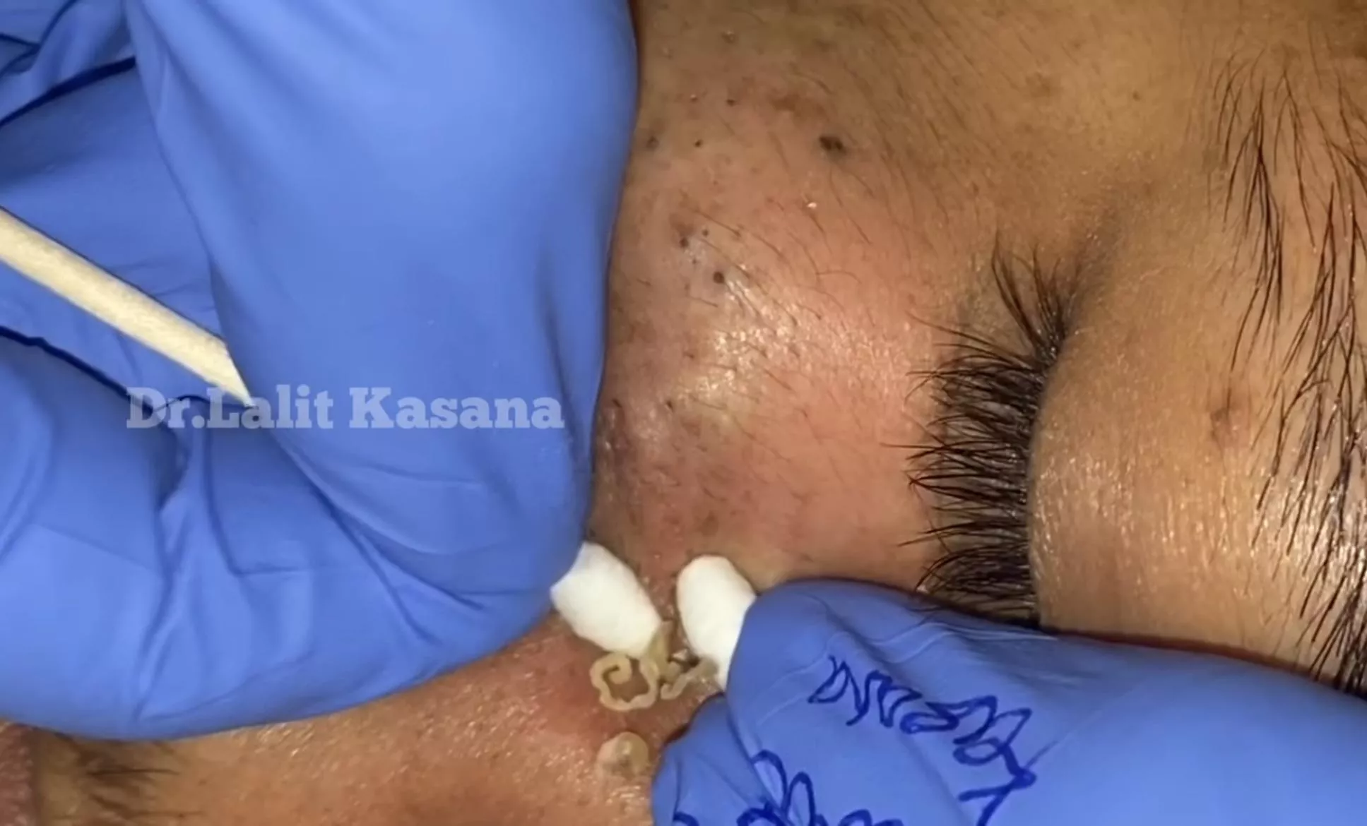 Goldmine of deep Blackheads (Dr.Lalit Kasana) Itâ€™s a repost but weâ€™ll worth another watch! Link in comments..