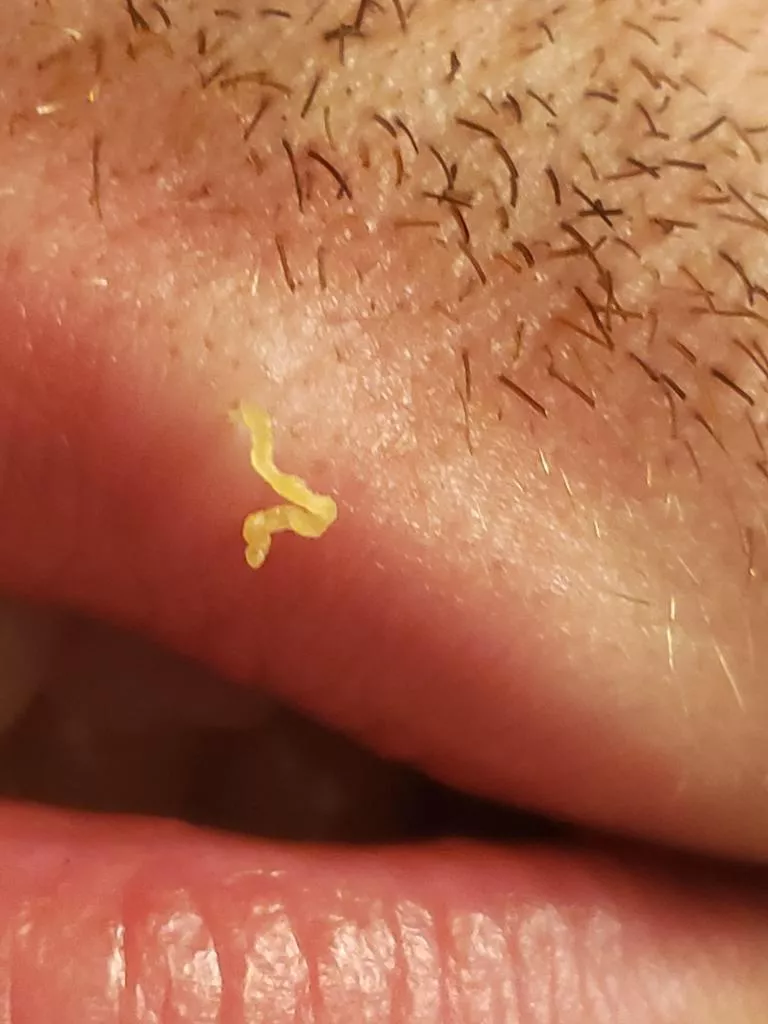 Got more than I was dreaming of with this blackhead on my upper lip