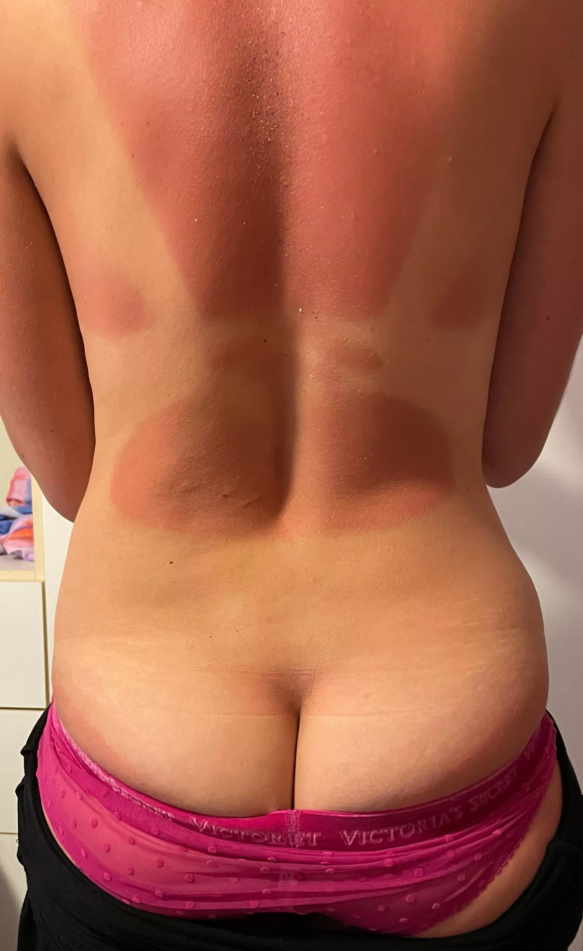 Guess I got carried away on vacation with no sunscreen