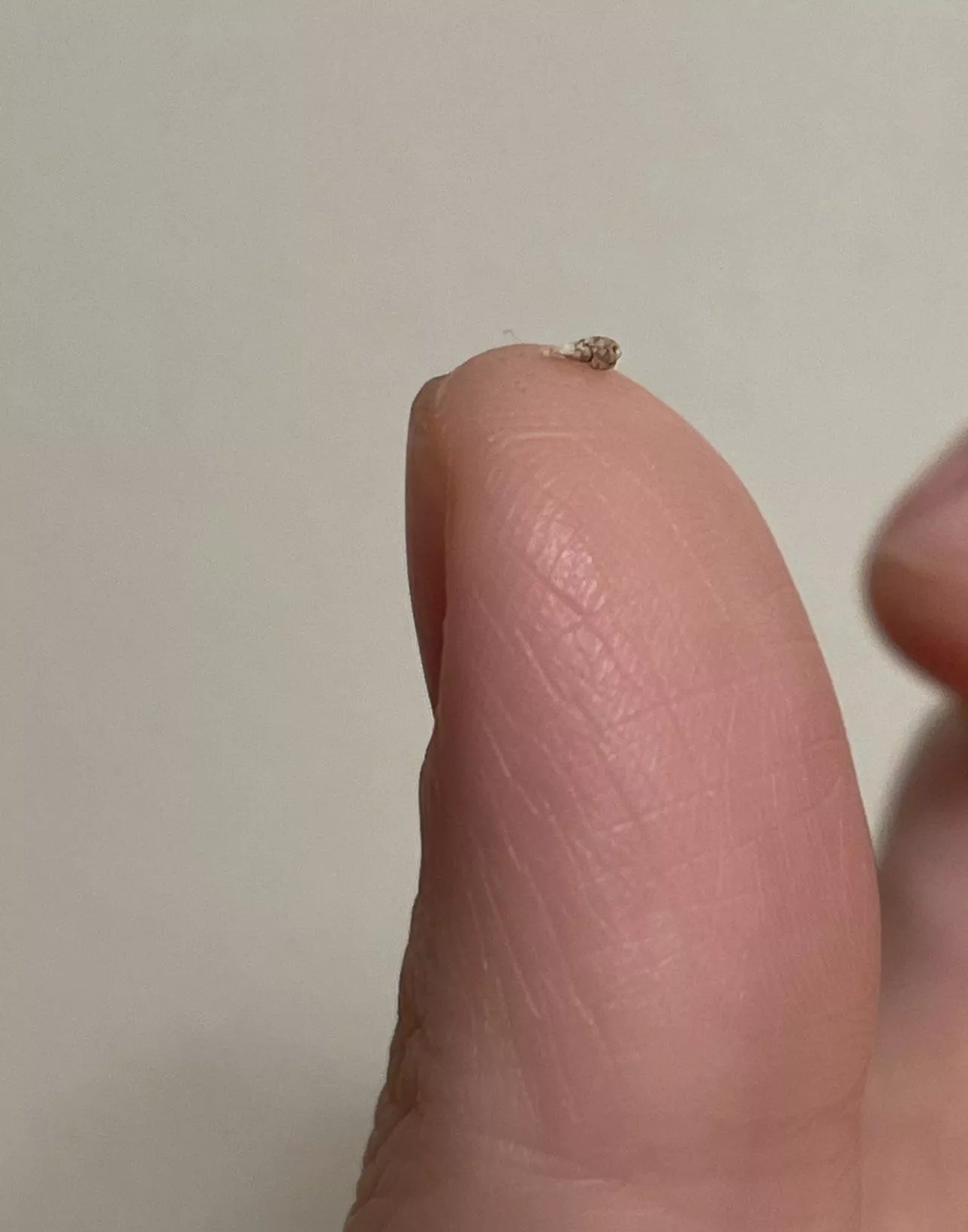 I accidentally scratched the pimple on my head (maybe an infected hair follicle, not sure) and when I squeezed it, this hard thing popped out.