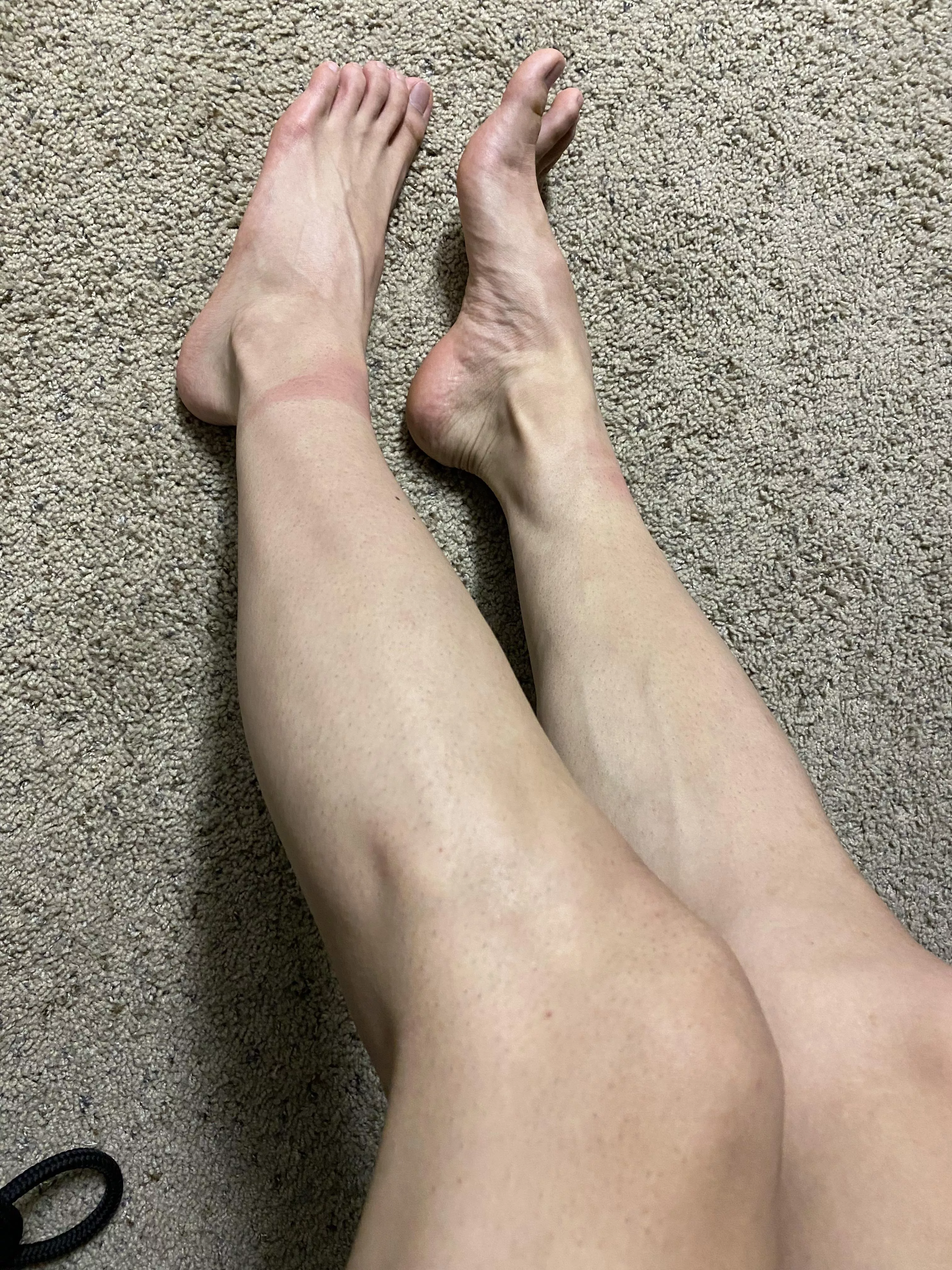 Marks on my smooth boy legs from a frogtie I was in for almost an hour