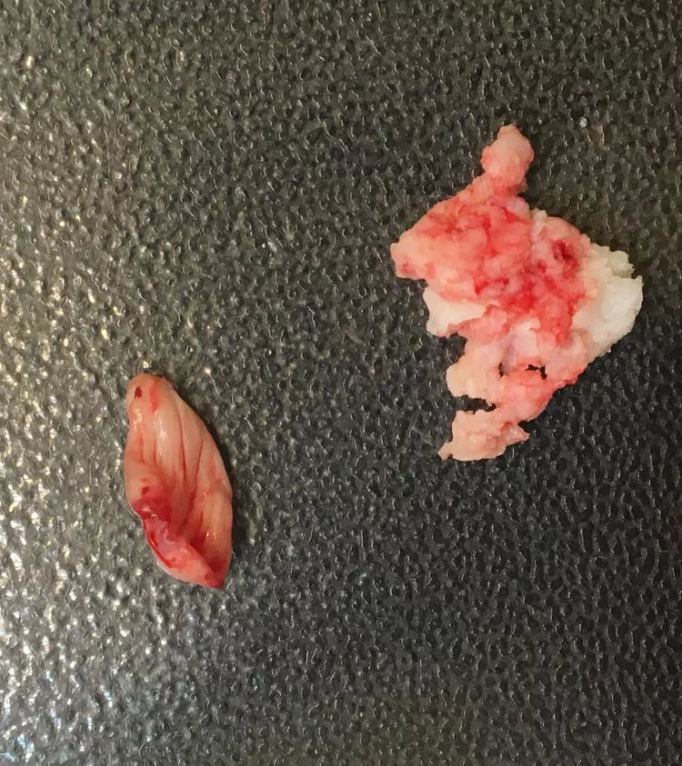 My cyst burst and I made my boyfriend pull the sac out of my shoulder while he was on LSD. He is NOT a popping fan!