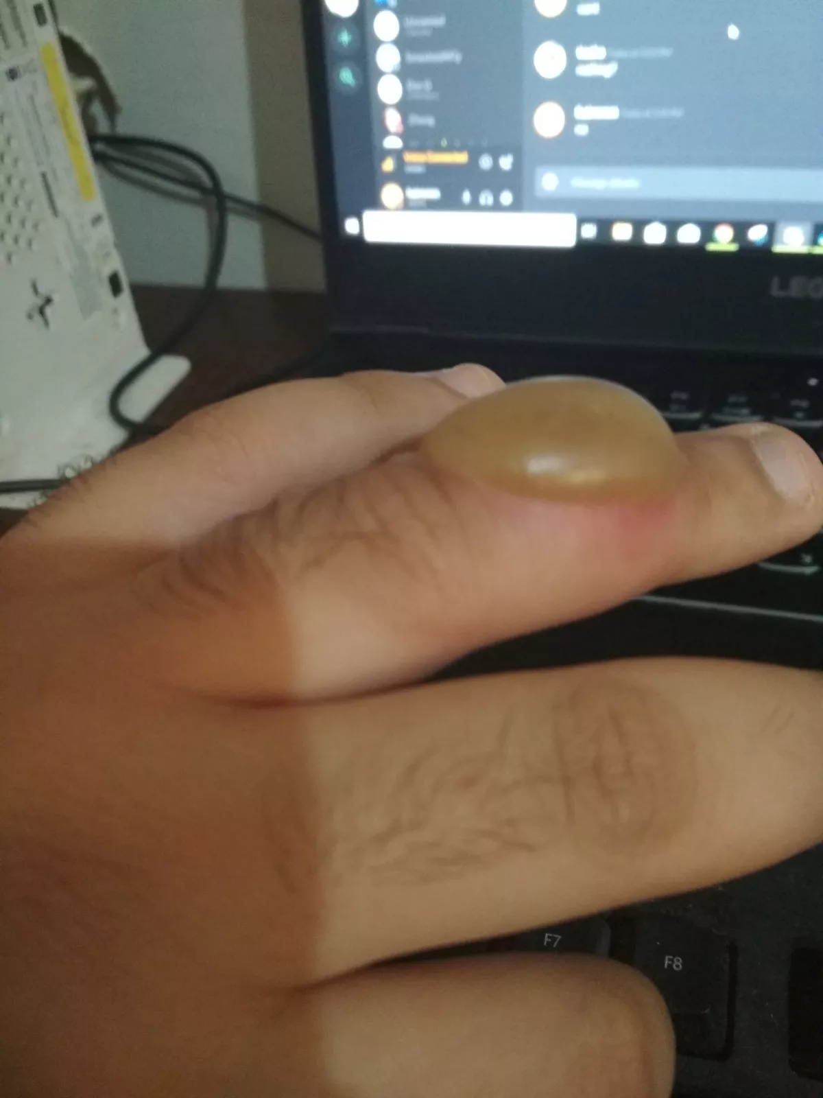 My finger after touching boiled oil then a glass of ice immediately after