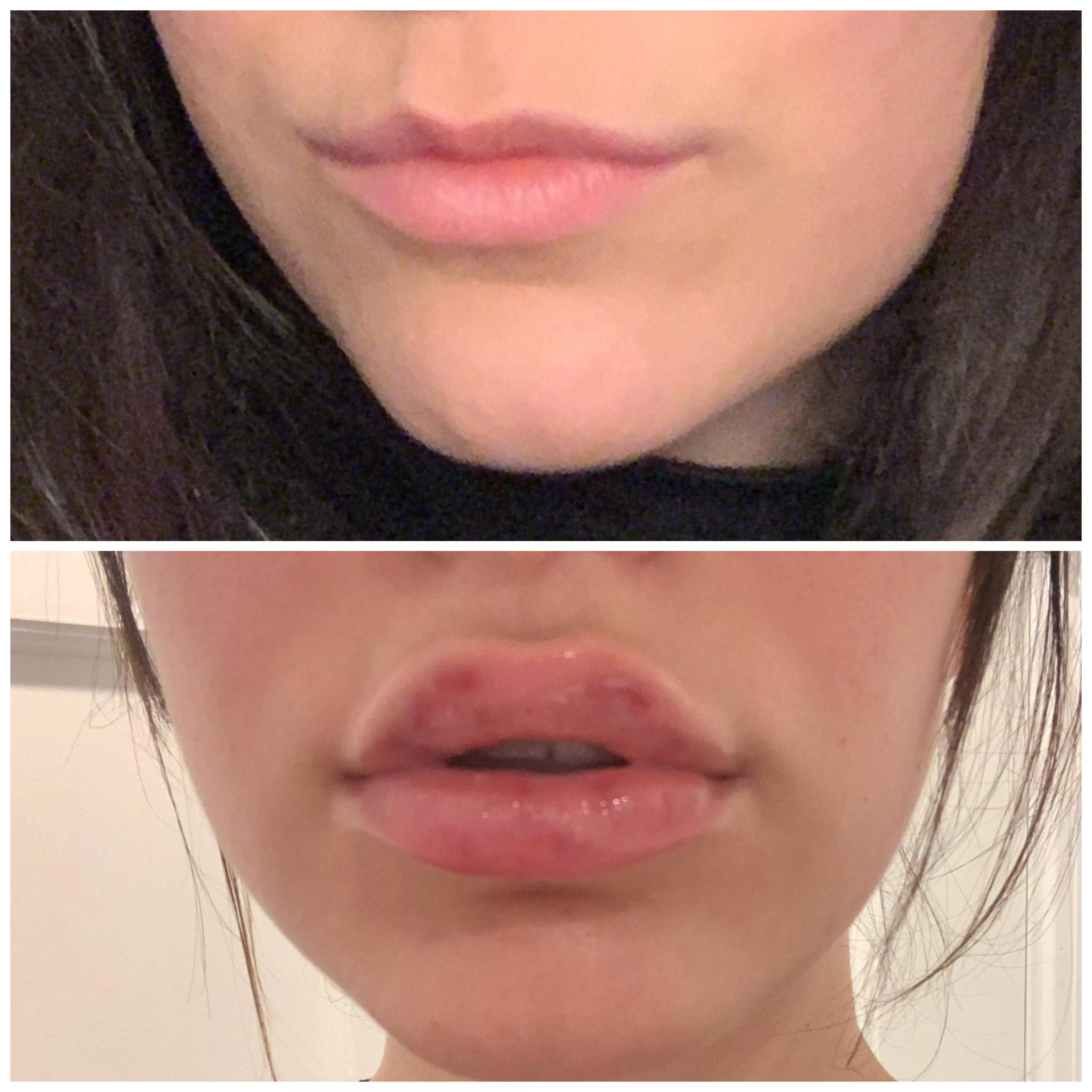 My new lips! One syringe later and I finally have a luscious bimbo top lip (and bottom of course)