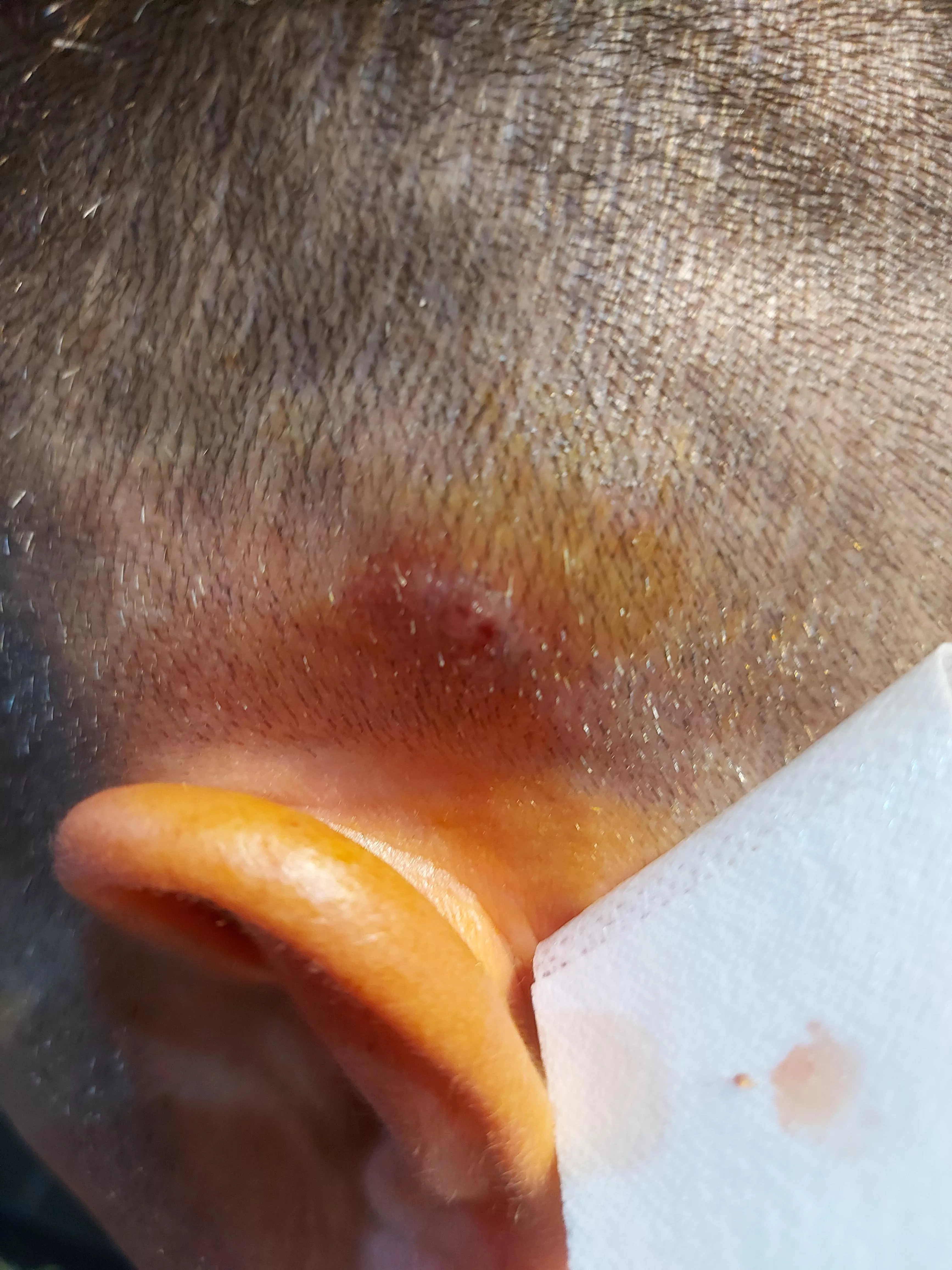 No idea what's that. Probably cyst or some kind of lipoma. Tried to squeeze it(with gloves ofc). But only blood and some brown pus came out. It's on my mother's boyfriend's side of head. He said that it just grew in a day. Cleaned with betadine and d