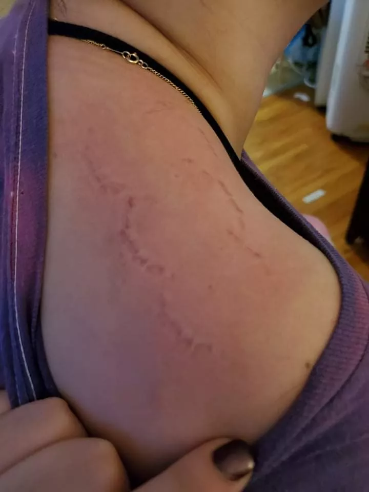 Nothing like a fresh bite mark! I love watching how pink my skin gets