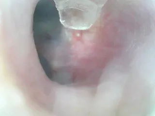 [OC] Forbidden pop- a whitehead on my eardrum?? How does that even happen??