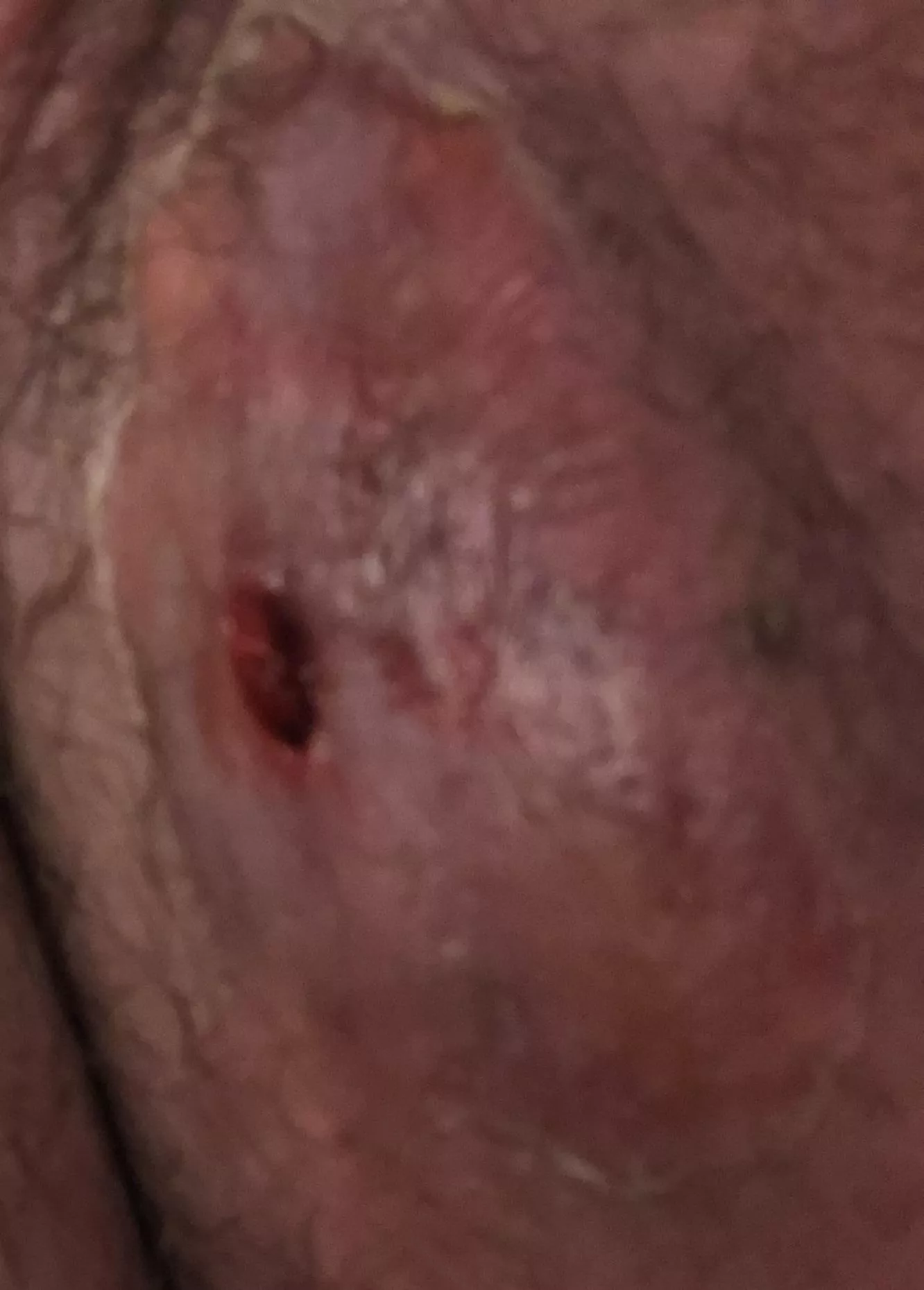 Possibly my final update. Unfortunately I never got to film it and all that’s left is a bloody hole. Now I’m just looking for ways to make sure it doesn’t get infected while healing