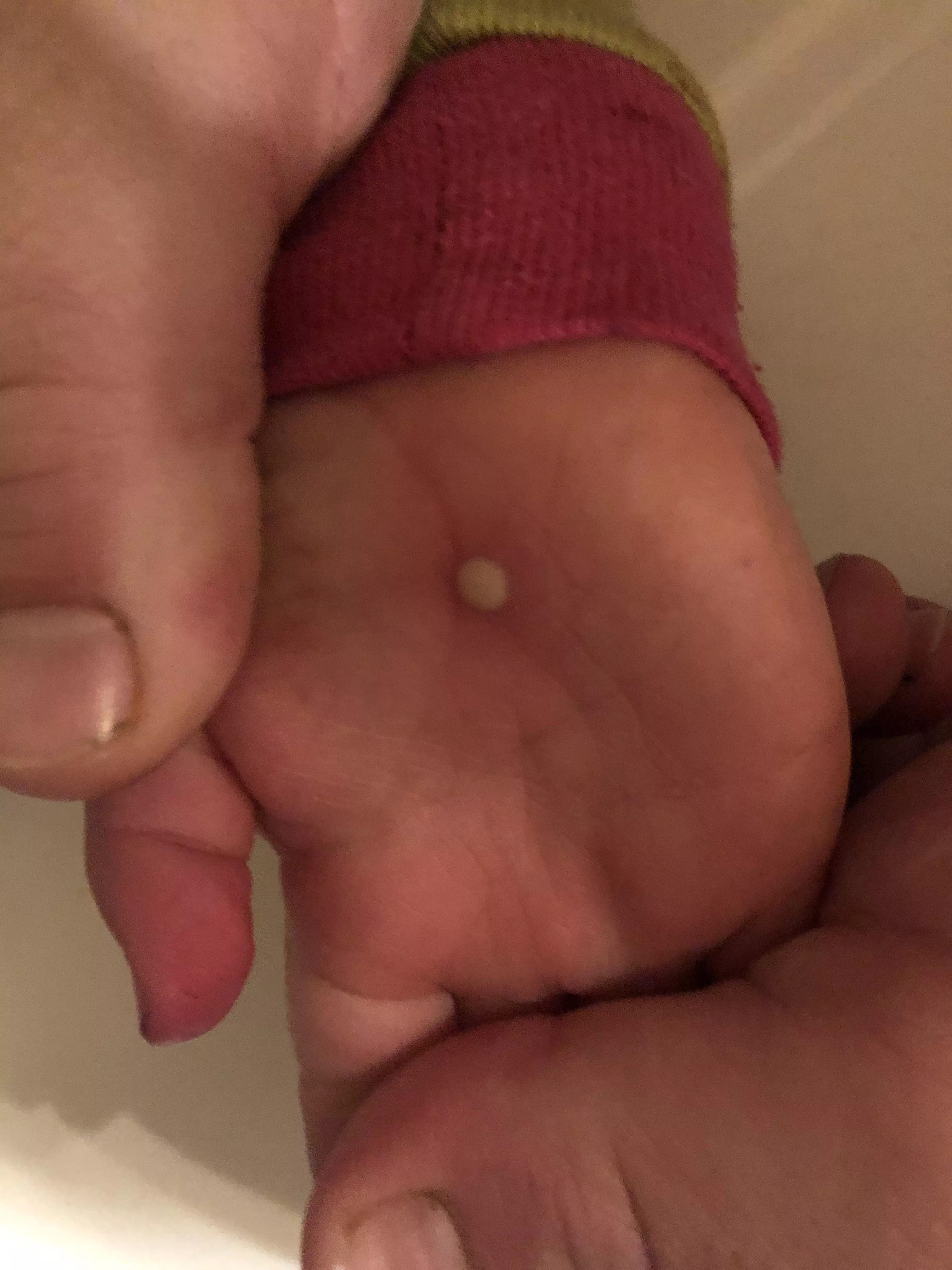 Random forbidden pop on 2 y/o daughter’s hand. No idea where it came from and it just keeps getting bigger.