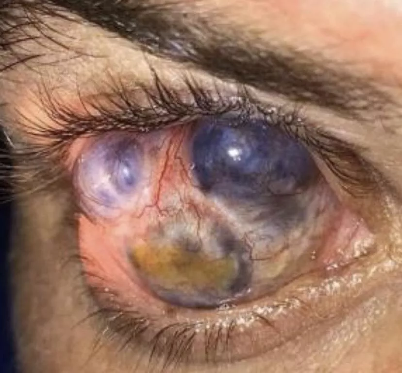 Scleromalacia Perforans, a type of inflammation of the eye.