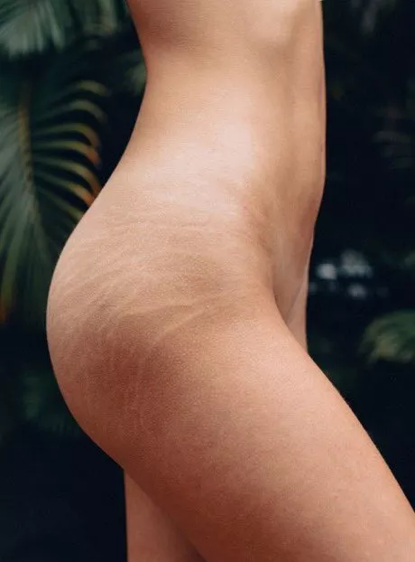 Stretch marks