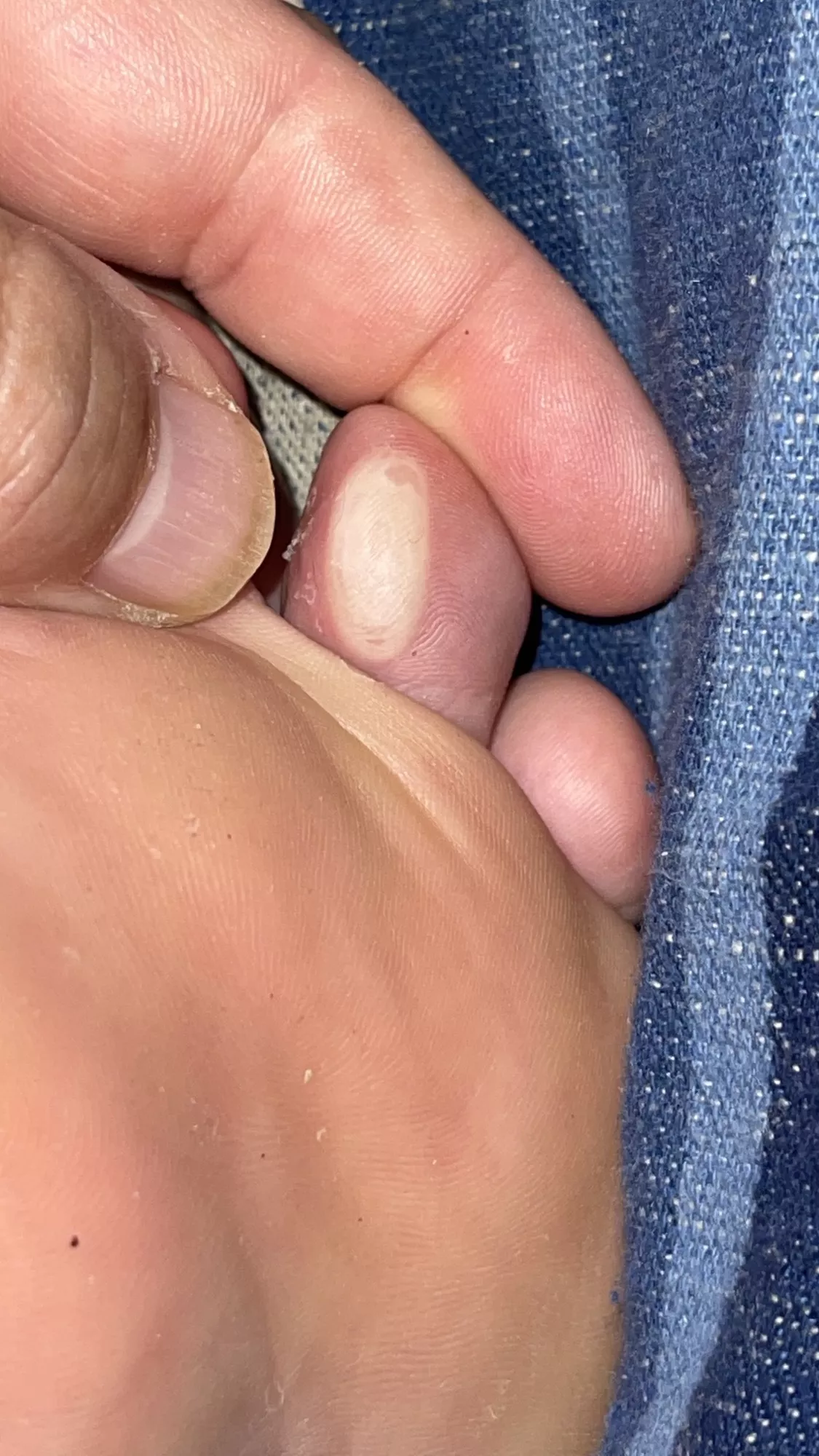 Thank you Disney World for this three day walking blister. i’m surprised it never popped.