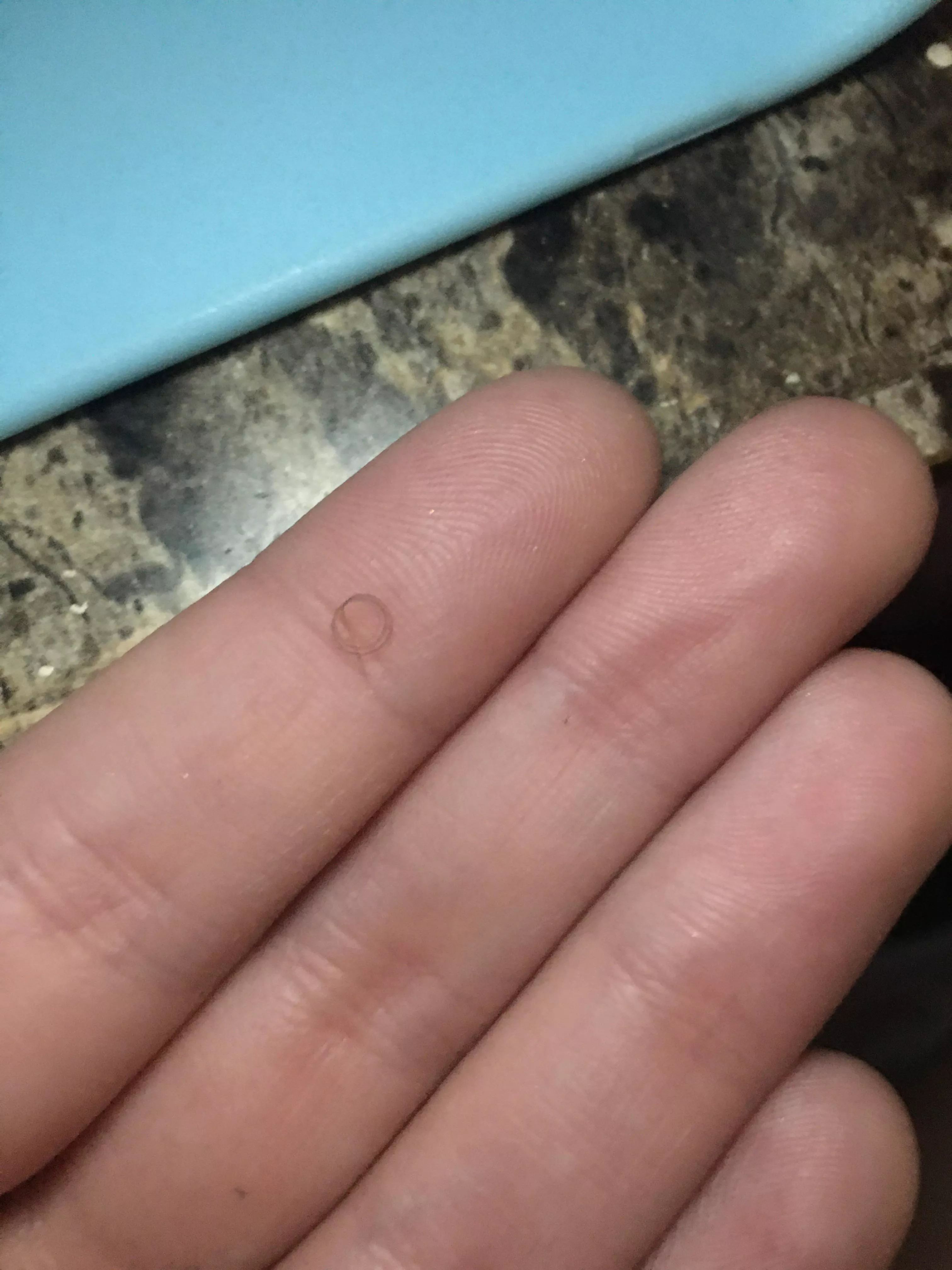 This was the ingrown hair from my pubic area. I got it out after. OC. Cont.