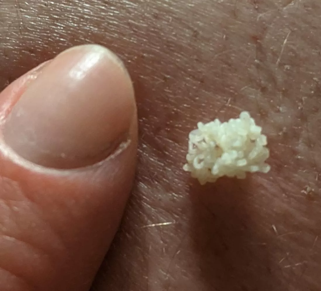 Thought y'all would enjoy this beautiful coral cloud that came out of a neverending blackhead on my bf's back (it refills every few months, thankfully)