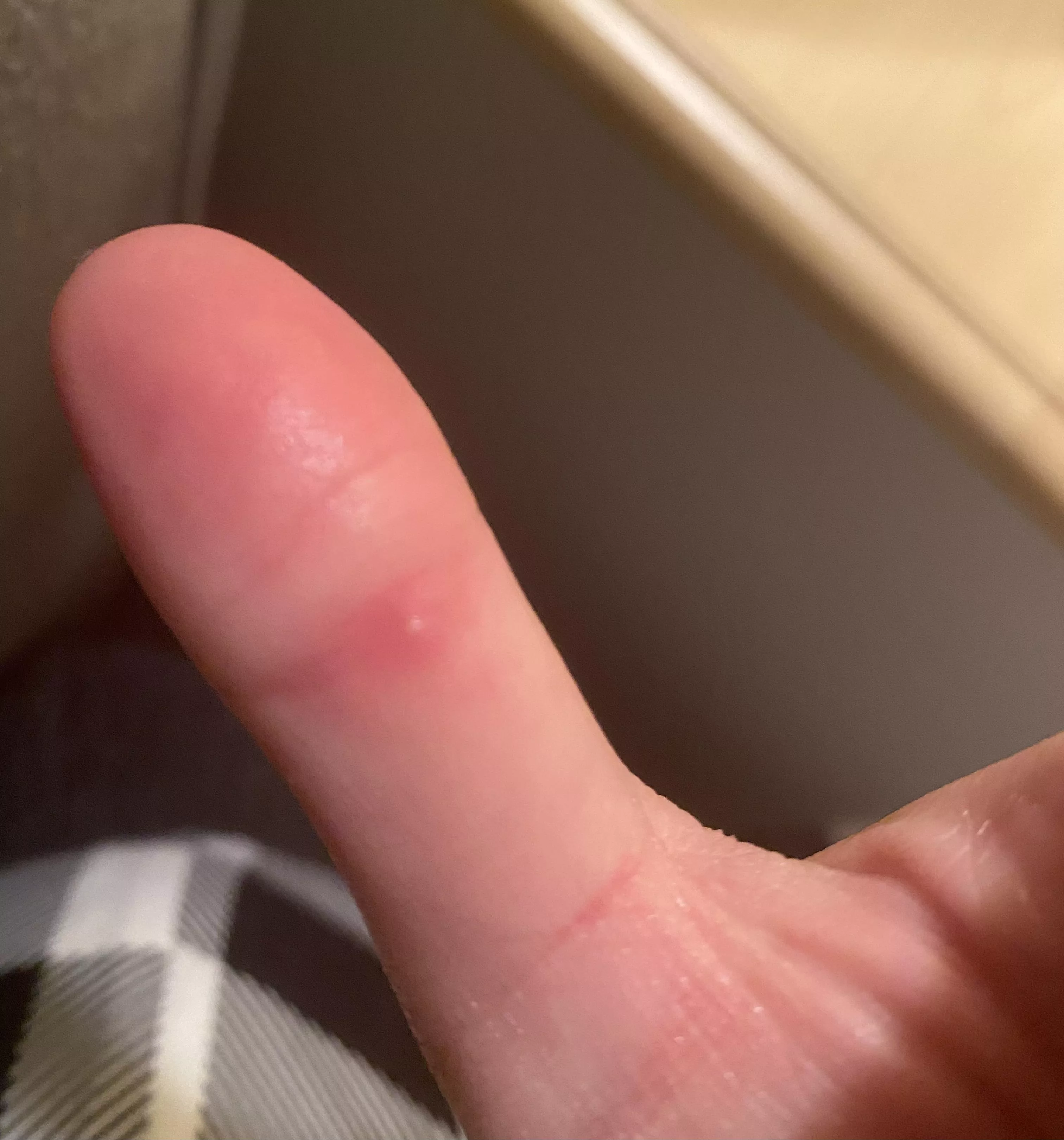 Tiny, painful, hard white bump right on the inside of the knuckle on my thumb. This is what I presume is a forbidden popâ€¦ has anyone else gotten something like this before? It hurts like mad to bend my thumb. Itâ€™s hard to see but the center of the bu