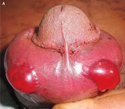 Viper snake bite of the penis while a farmer was urinating in the open field