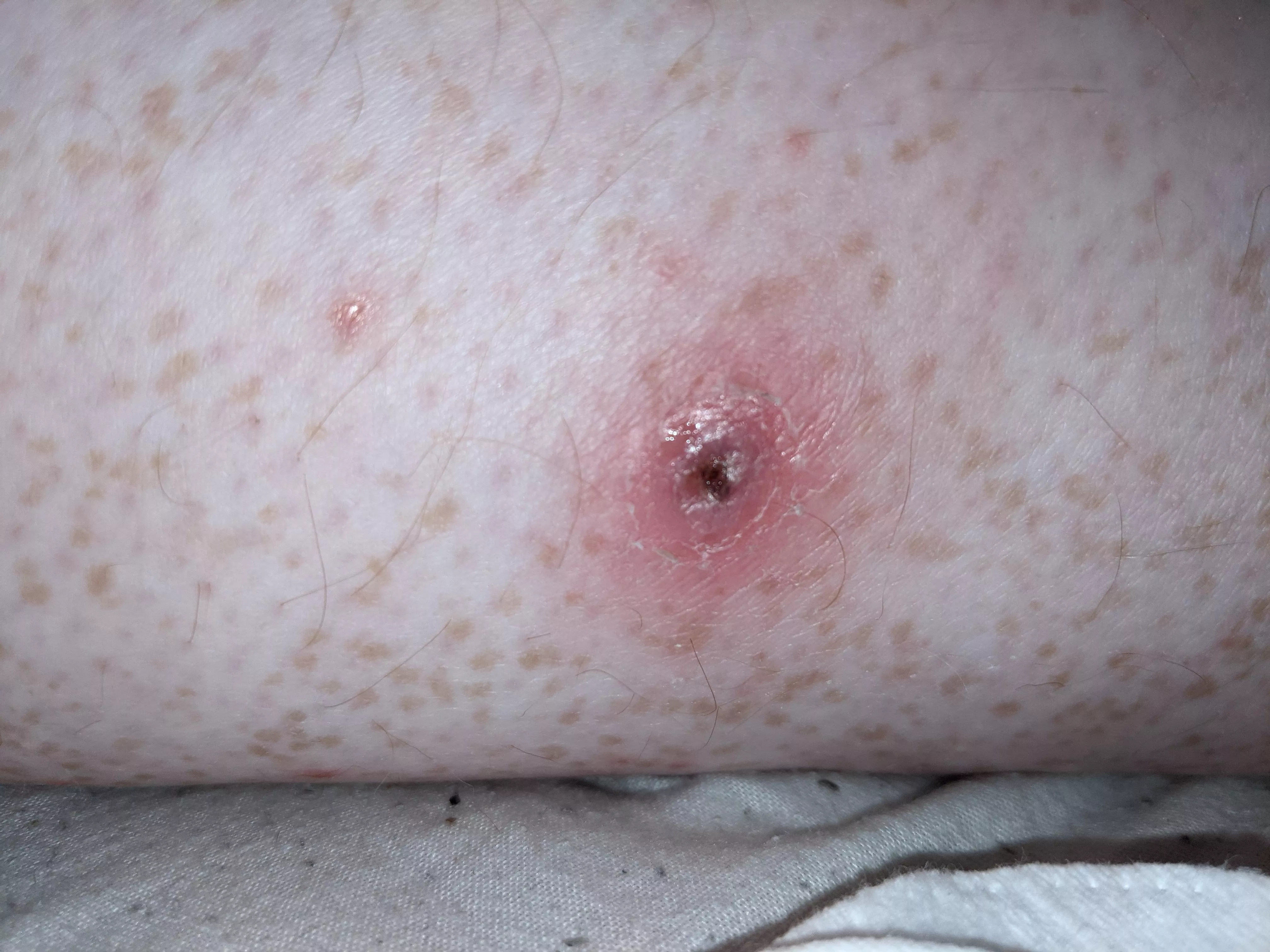 Waiting for the gp to call me back about this little fucker. Had it about a week now, keeps refilling and popping. I'm guessing some kind of skin infection but not 100% sure.