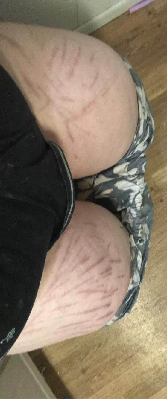 we still appreciate scarred thighs right? 🥺 dm me for more content