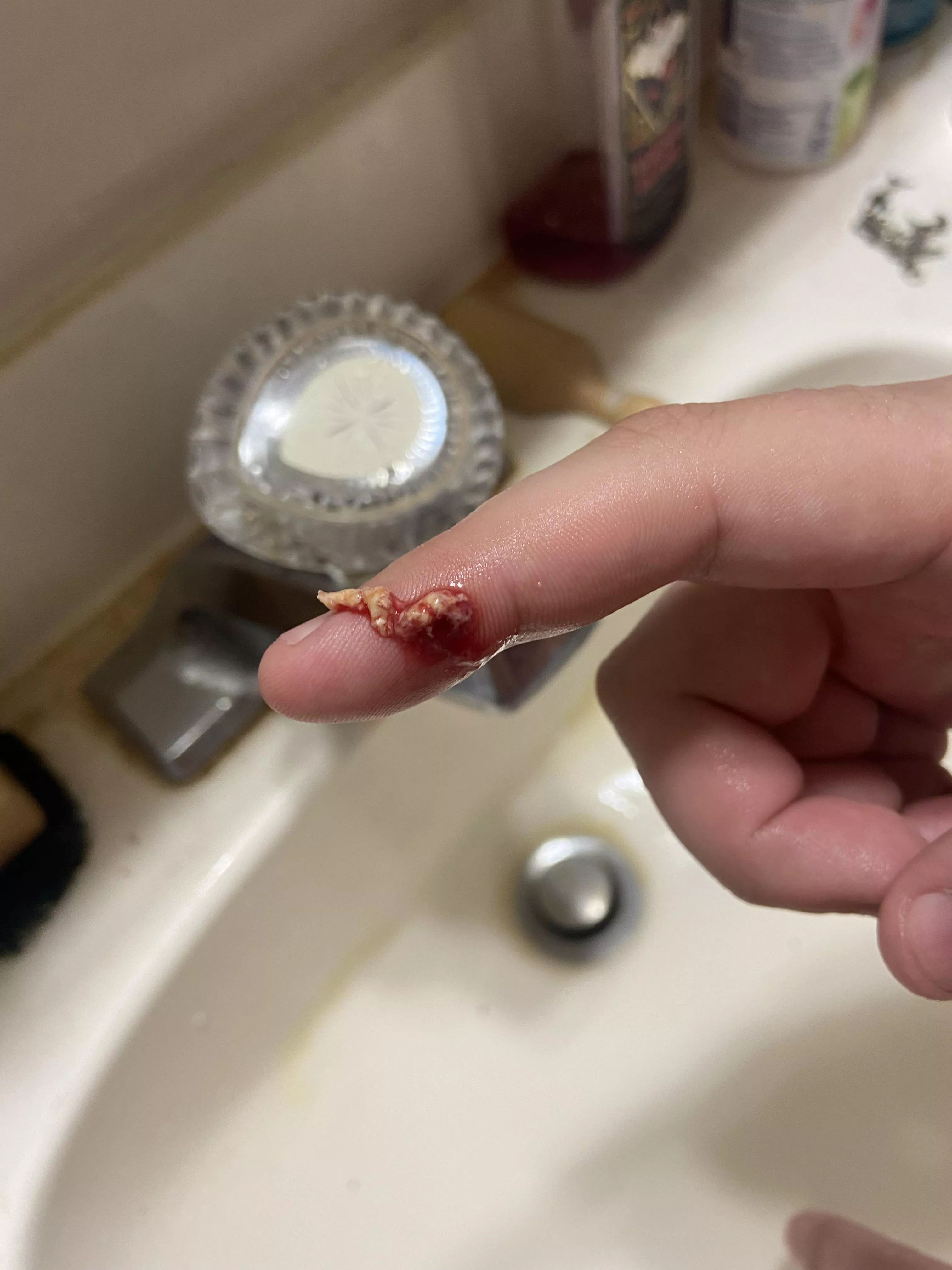 What came out of an Infected pimple/boil (no video unfortunately)