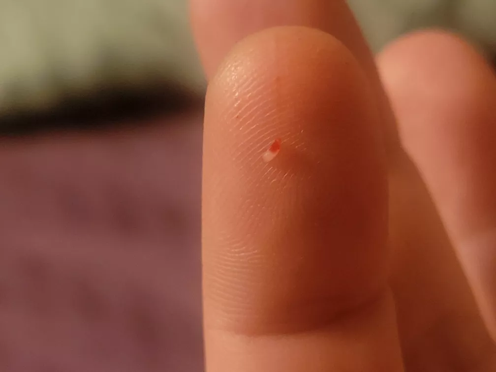 What is this? I get these hard sores for weeks and finally have to dig this little fucker out. The sores heal around it otherwise. Photo of hole in comments.