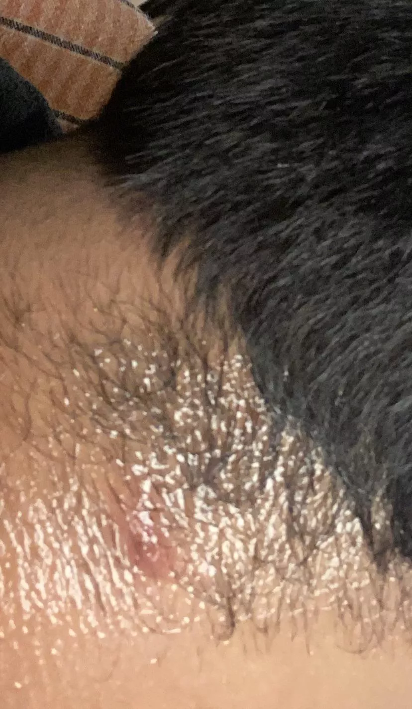 What kind of Cyst/Acne is this?