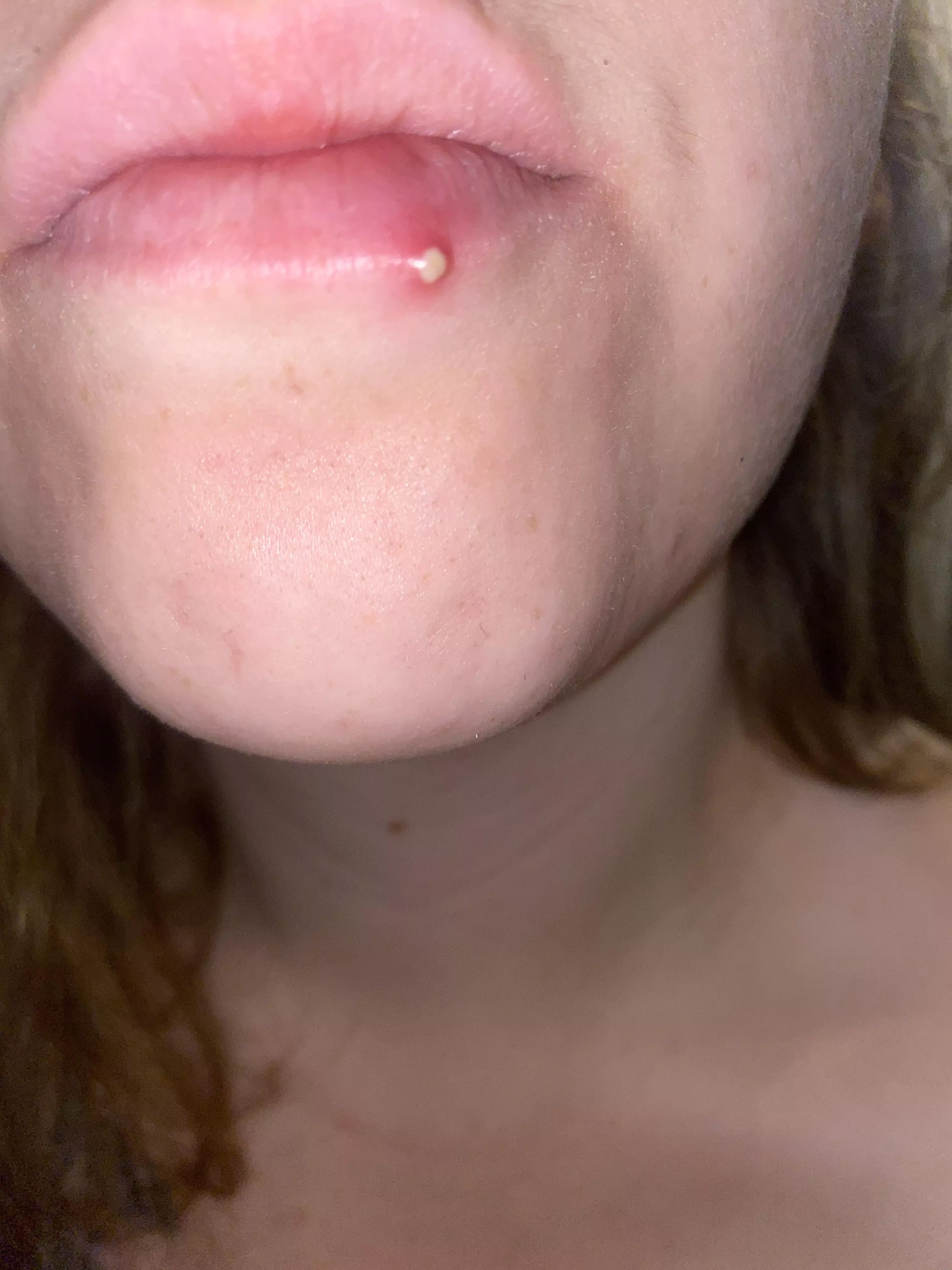 Woke up to this lip pimple! I could feel it grow throughout the night, but was surprised to see how white it was this morning! Maybe I’ll take a video of popping it.